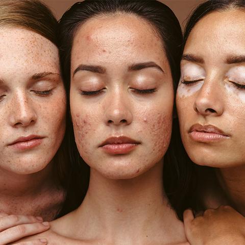 three ladies close up with unique skin conditions
